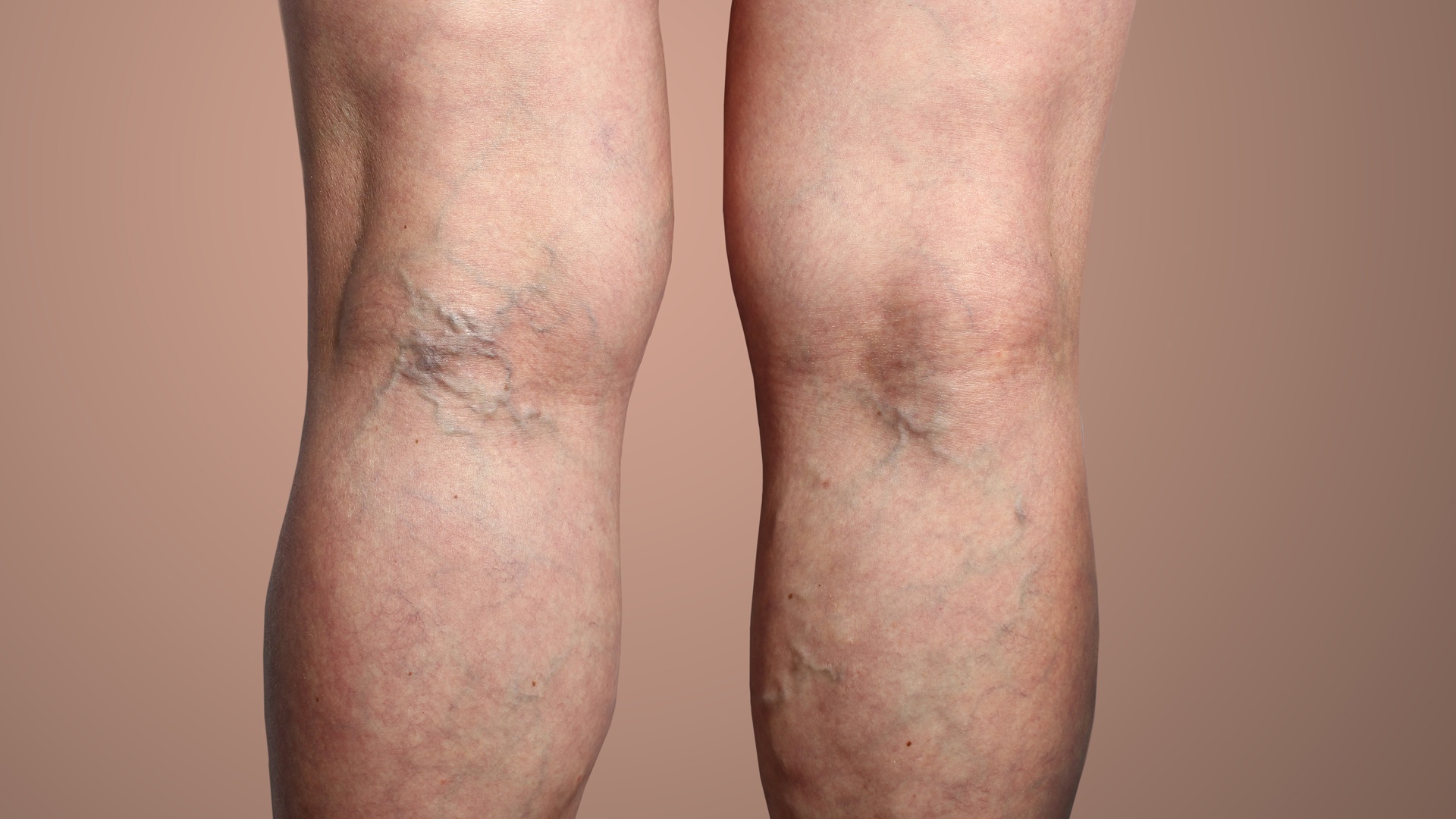 Tratamiento de varices sin cirugía en Mallorca